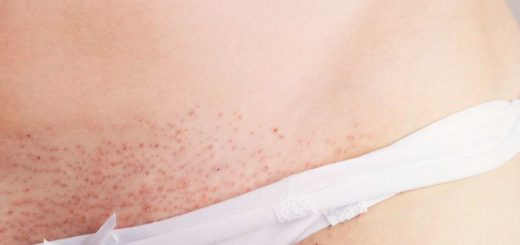 Как за 2 месяца убрать псориаз