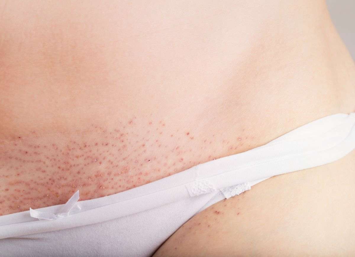 Как за 2 месяца убрать псориаз